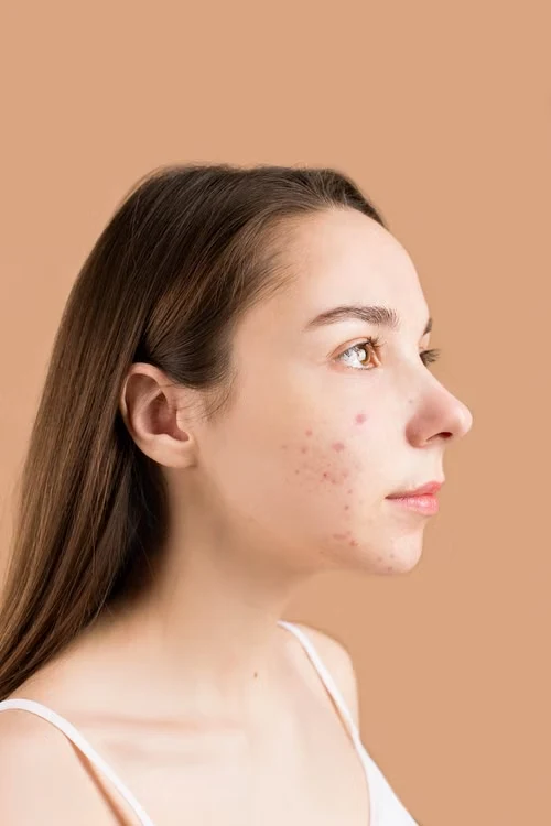 Acne Scar Reduction & Removal