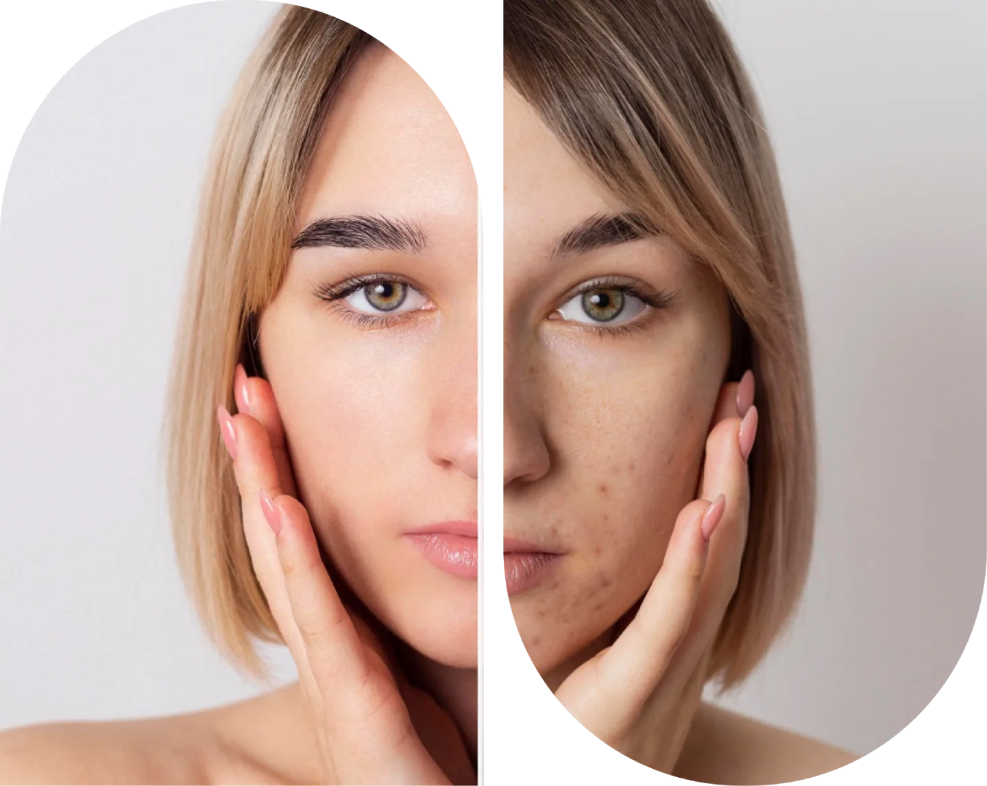 Acne Scar Reduction & Removal
