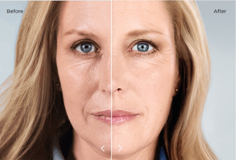 Sculptra (Biostimulator)