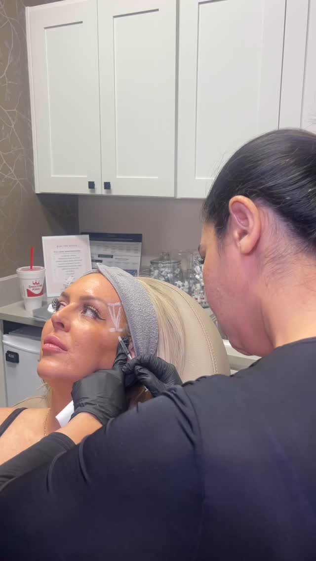 A simple treatment that isn't talked about enough - temple filler 💉🌟 Temple filler is amazing