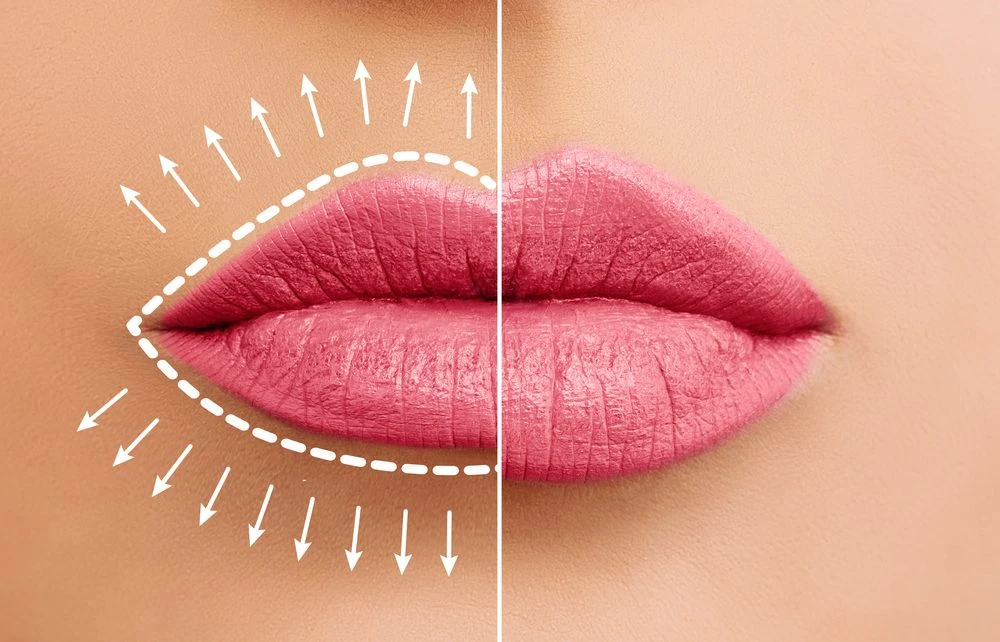 Do's and Don'ts after a Lip filler treatment