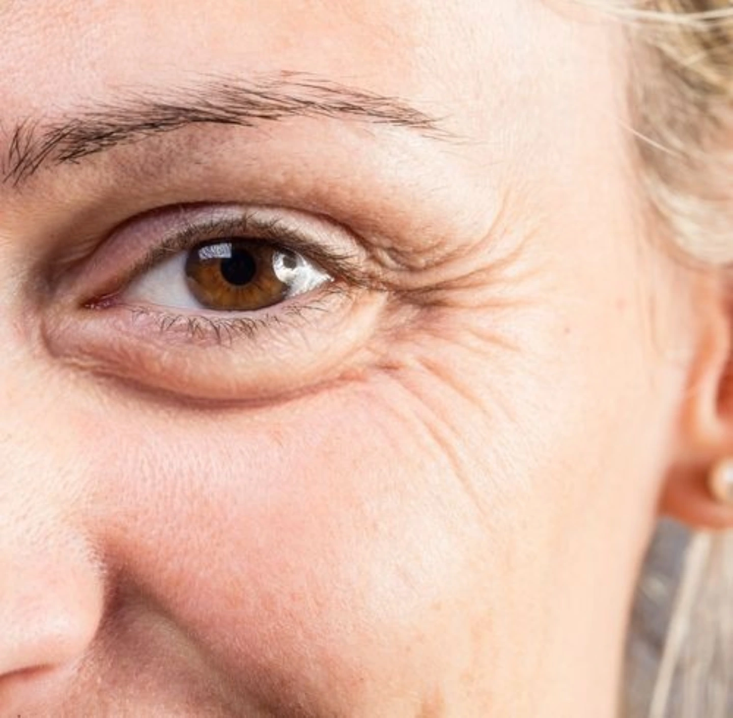 What Are Crow's Feet? Causes, Prevention & Treatment Options