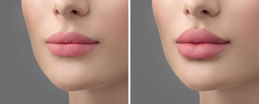 Before and After Lip Filler Injections
