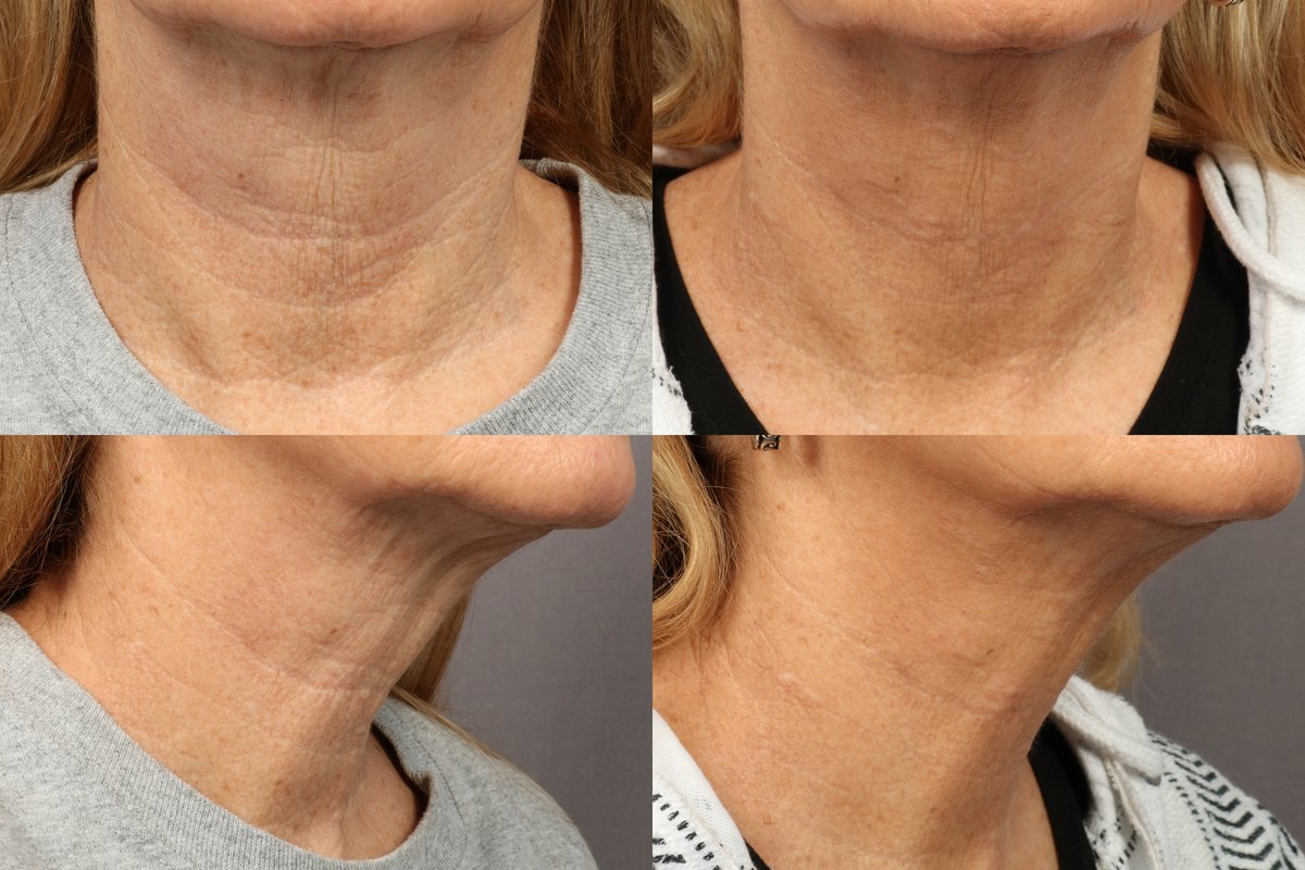 NECK