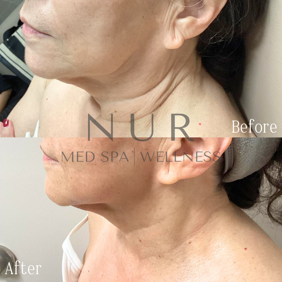NECK